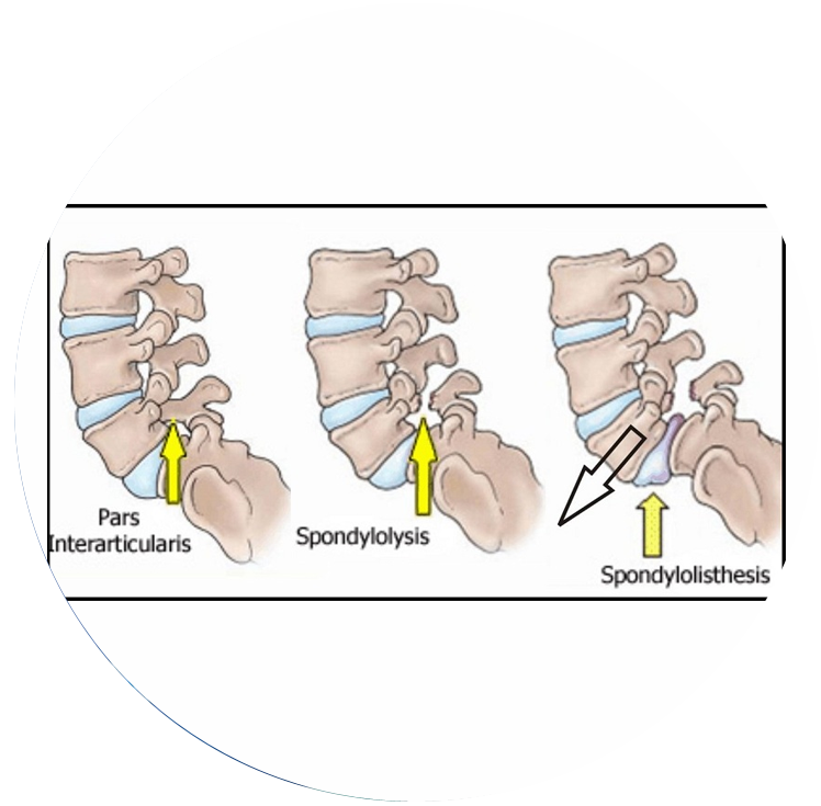 spondylolisthesis treatment in mumbai - dr yash shah