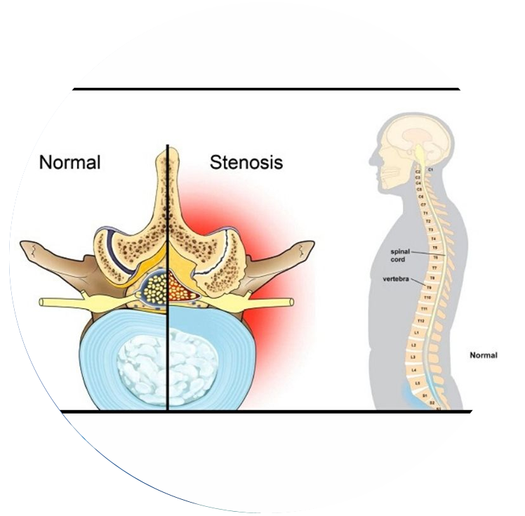 lumbar canal stenosis treatment in mumbai - dr yash shah