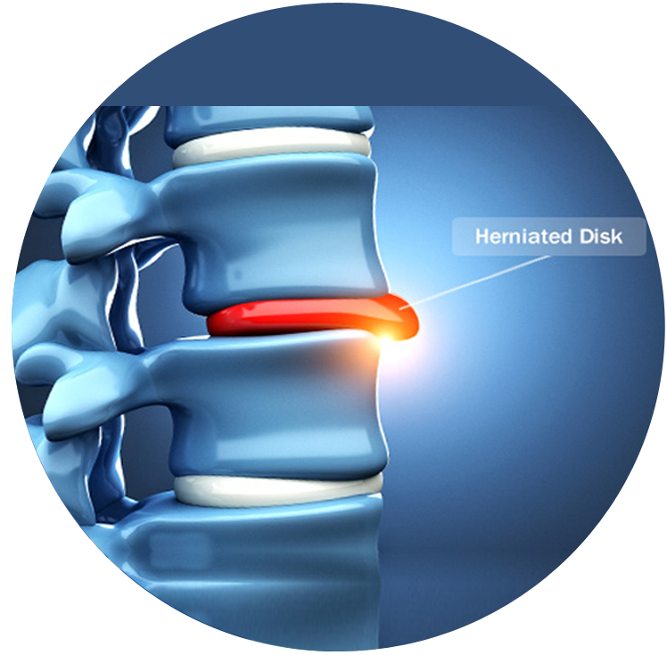 prolapsed / herniated / slip disc treatment in mumbai - dr yash shah