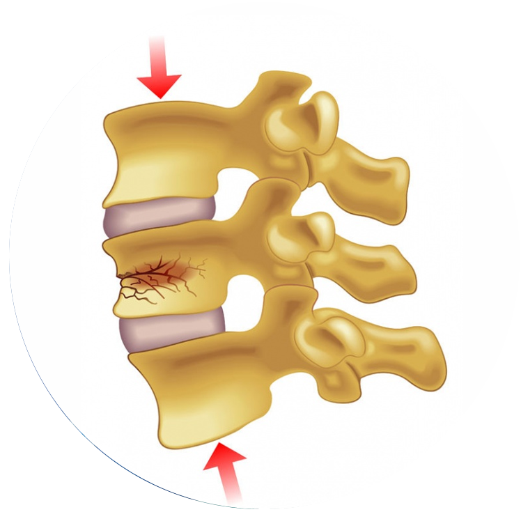 spinal fracture treatment in mumbai - dr yash shah